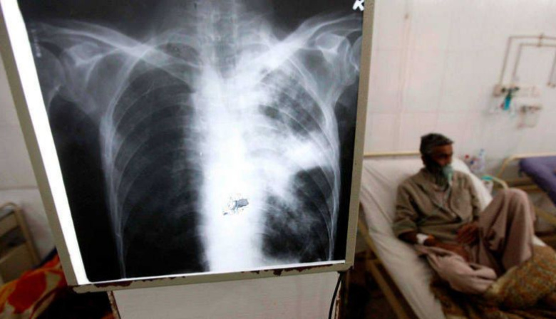 Piden a las provincias intensificar los controles ante aumento de casos de tuberculosis