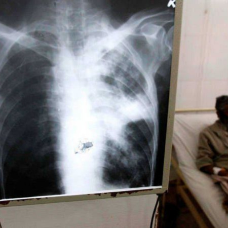 Piden a las provincias intensificar los controles ante aumento de casos de tuberculosis